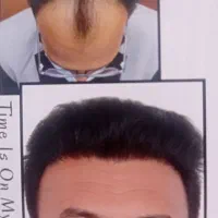 کاشت مو طبیعی