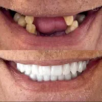دندانپزشکی، کامپوزیت دندان|خدمات آرایشگری و زیبایی|تهران, تهرانپارس غربی|دیوار