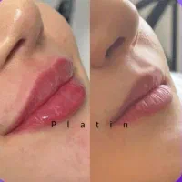 تزریق ژل و بوتاکس،جوانسازی، مزوژل و لیفت نخ