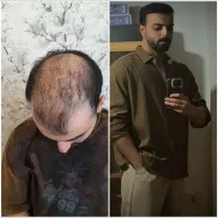 کاشت مو دائمی با تراکم بالا