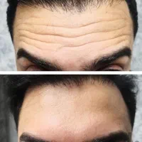 بوتاکس،تزریق ژل،مزوزیرچشم وصورت ،پرسینگ محمدشهر|خدمات آرایشگری و زیبایی|محمدشهر, محمدشهر|دیوار