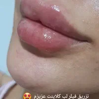 تزریق فیلر و بوتاکس|خدمات آرایشگری و زیبایی|قرچک, مهدیه|دیوار