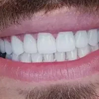 ایمپلنت دندان کره ای با روکش 14/600 تومان بدون درد