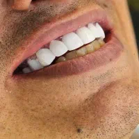 ایمپلنت لمینت ونیر و‌خدمات دندانپزشکی