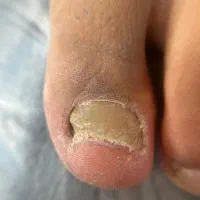 فرورفتگی ناخن توگوشت|آرایشی، بهداشتی، درمانی|انار, |دیوار