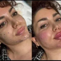 ژل بوتاکس فیلر انزیم.زاویه.پی آرپی