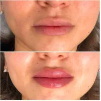 اف ویژه برای اموزش و خدمات ژل و بوتاکس.فیلر بادی