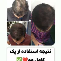 درمان ریزش مو