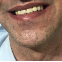 ساخت پروتز متحرک|آرایشی، بهداشتی، درمانی|آمل, |دیوار