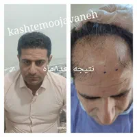 کاشت موبه سبک شیرازی ۳۰درصدتخفیف