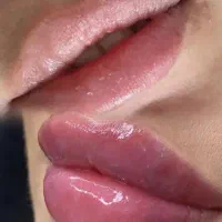 فیلرژل لب چونه گونه زاویه فک..توسط پیراپزشک|خدمات آرایشگری و زیبایی|زاهدان, |دیوار