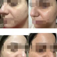 تزریق ژل بوتاکس مزونیدلینگ ، مزوسروابرو ،فیلربادی|خدمات آرایشگری و زیبایی|تهران, نیروی هوایی (پیروزی)|دیوار