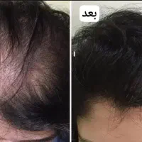 رویش مجدد مو تضمینی