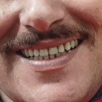 ساخت انواع دندان مصنوعی با بیش از نیم قرن تجربه