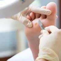 زگیل برداری میخچه برداری و...|خدمات آرایشگری و زیبایی|ارومیه, |دیوار