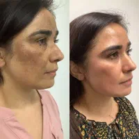 ضدلک تضمینی