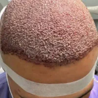 کاشت مو وابروتخصصی|خدمات آرایشگری و زیبایی|خرمشهر, |دیوار