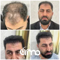 کاشت مو ابرو ریش تکنسین شیرازی|خدمات آرایشگری و زیبایی|قزوین, |دیوار