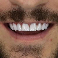 طراحی لبخند با لمینت و کامپوزیت