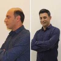کاشت‌موی طبیعی اقساطی و‌شرایطی با ۲۵ پرتراکم|خدمات آرایشگری و زیبایی|تهران, ونک|دیوار