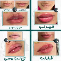 بوتاکس فیلر(ژل) مزوتراپی، پی ار پی درمطب گلسار رشت|خدمات آرایشگری و زیبایی|رشت, گلسار|دیوار