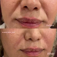 تزریق فیلر و بوتاکس