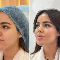 فول فیس ژل لب فیلربیکینی تخفیفات فقط دو روز|خدمات آرایشگری و زیبایی|مشهد, احمدآباد|دیوار