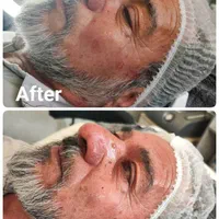 خال برداری/کک و مک/منگوله/ماه گرفتگی/روشن سازی