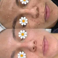 خروج لک و کک مک جای جوش با درمان تلفیقی|خدمات آرایشگری و زیبایی|سبزوار, کاشفی شمالی (دادگستری)|دیوار