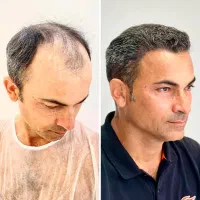کاشت مو و ابرو آقایان و بانوان طی ۶ قسط