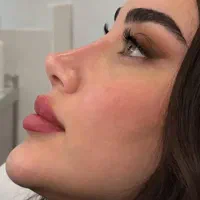 عمل بینی درشیراز / شروع از ۷۹میلیون با شرایط اقساط