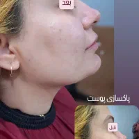 تا آخرهفته، مدل پاکسازی فقط با 198تومن|خدمات آرایشگری و زیبایی|رشت, جهاد|دیوار