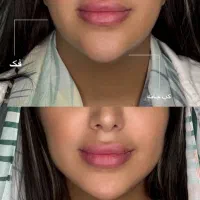 تزریق لب روسی/فیلر بادی/بوتاکس/مزوژل/prp|خدمات آرایشگری و زیبایی|تهران, تهرانپارس غربی|دیوار