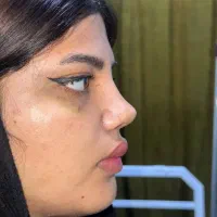تخفیف جراحی بینی فقط( ۴۵)اهواز