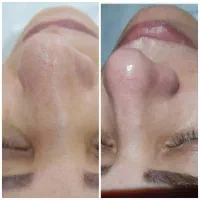 خدمات تخصصی پاکسازی و فیشیال پوست