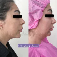 لیپوفیس سوپرکانتور ساکشن غبغب لیپوغبغب لاغری غبعب