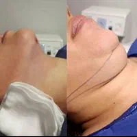 ساکشن غبغب شکم پهلو|خدمات آرایشگری و زیبایی|شیراز, عفیف‌آباد|دیوار