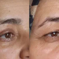 بلفاروپلاستی و لیفت ابروبا دادن گواهی ب بیمه تکمیل