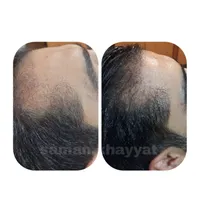 مزوتراپی وprp پوست ومو،فیشیال،مزوژل بوتاکس در مطب|خدمات آرایشگری و زیبایی|شیراز, سجادیه|دیوار