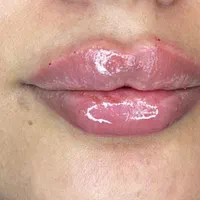 تزریق ژل اصلی ۳۸۰  و بوتاکس فول فیس بانصف قیمت|خدمات آرایشگری و زیبایی|اسلام‌شهر, شهرک واوان|دیوار
