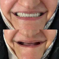 دندان مصنوعی + اقساط با چک + با گارانتی|خدمات زیبایی و سلامت|تهران, مهرآباد|دیوار