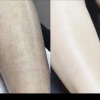 لیزر موهای زائدبدن باقیمت باورنکردنی به مدت محدود