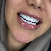 زیبایی دندان