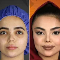 لیفت فول فیس صورت و شقیقه بدون عمل جراحی