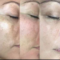 جشنواره هایفوتراپی vip همراه فیشال اشانتیون|خدمات آرایشگری و زیبایی|رشت, رودباری|دیوار