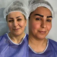 کاشت فول تراکم ابرو ۱۲۸۰۰