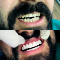 جشنواره تخفیف کامپوزیت دندان / مواد درجه یک|خدمات زیبایی و سلامت|کرج, کرج نو|دیوار