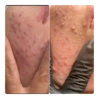 اموزش فیشال وکربوکسی و میکرونیدلینگ|خدمات آموزشی|یزد, |دیوار