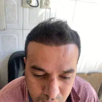 کاشت مو و ابرو حرفه ای متدد روز