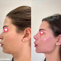 تخفیفات ویژه آموزش فیلر(ژل)، بوتاکس،لیفت بانخ